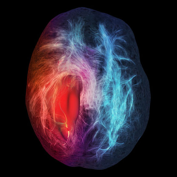cerebral-infiltration